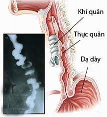 Làm gì với chứng co thắt thực quản?  1