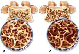 Phân biệt bệnh nhuyễn xương và loãng xương 1