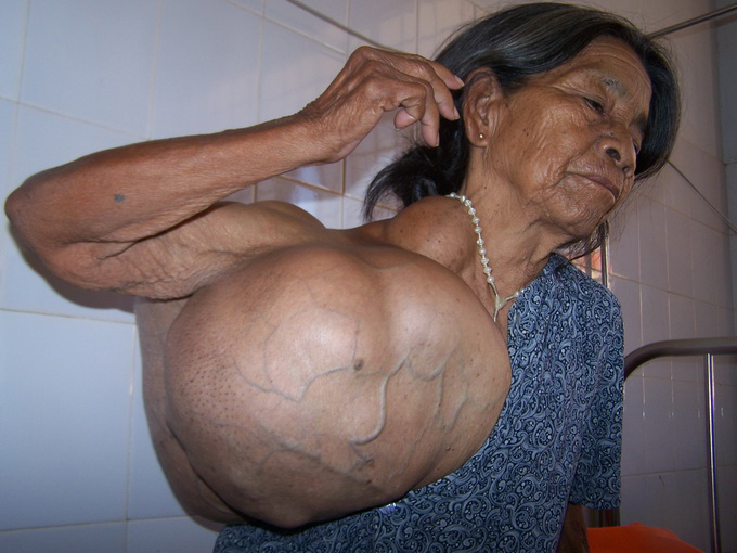 Lần đầu tiên phẫu thuật thành công khối u phức tạp nặng hơn 10kg 1