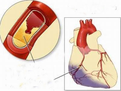 Vùng cơ tim bị tổn thương màu sẫm.