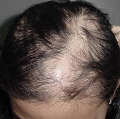 Bệnh rụng tóc và cách chữa