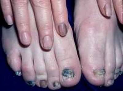 Một trong những nguyên nhân của móng chân đen có thể là do nấm móng chân. Tuy nhiên, không phải tất cả các trường hợp đều như vậy. Hãy tìm hiểu về nấm móng chân và các yếu tố gây ra móng chân đen để có thể chữa trị vấn đề này một cách đúng đắn.