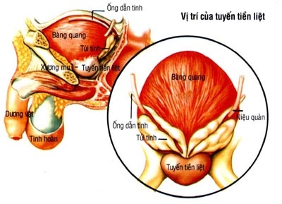 Tiểu đêm do phì đại tuyến tiền liệt 2