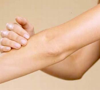 Đau vùng khuỷu tay khi vận động, chữa thế nào? 1 Đau vùng khuỷu tay khi vận động, chữa thế nào? 1