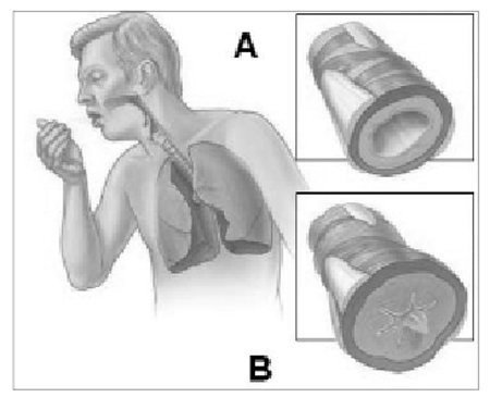 Phù mạch đường hô hấp trên do thuốc và cách đối phó 1 Phù mạch đường hô hấp trên do thuốc và cách đối phó 1