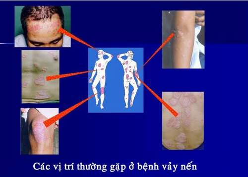 Bệnh vảy nến có thể điều trị khỏi? 1