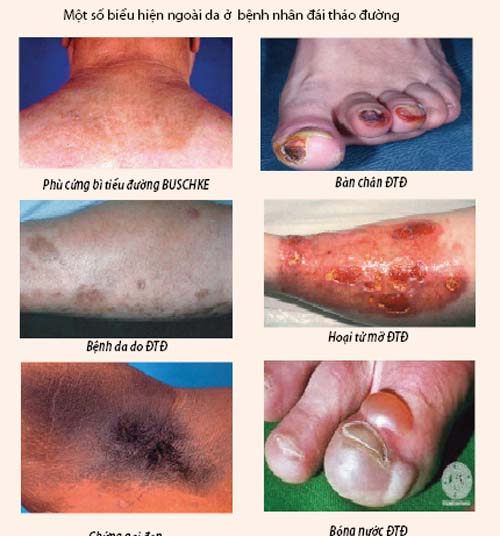 Các biểu hiện ngoài da ở bệnh nhân đái tháo đường 2 Các biểu hiện ngoài da ở bệnh nhân đái tháo đường 2