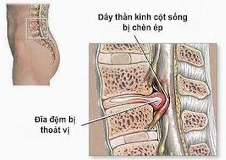 Thoát vị đĩa đệm điều trị có khó? 1 Thoát vị đĩa đệm điều trị có khó? 1