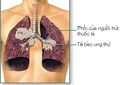 Những nguy cơ dẫn đến ung thư phổi 1 Những nguy cơ dẫn đến ung thư phổi 1