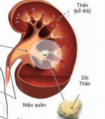 Tiểu ra máu: Bệnh gì? 2