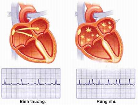 Rung nhĩ - Coi chừng biến chứng! 1