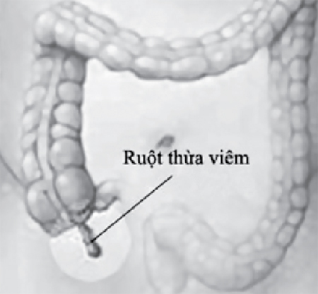 Nguyên nhân gây đau vùng tiểu khung? 1