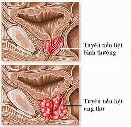 Thuốc điều trị ung thư tuyến tiền liệt đã tiến triển 1