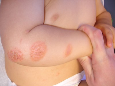 Cách ngừa viêm da dị ứng? 1