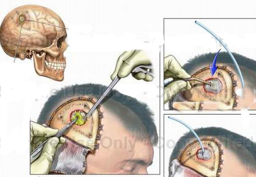 Phát hiện sớm áp-xe não 2