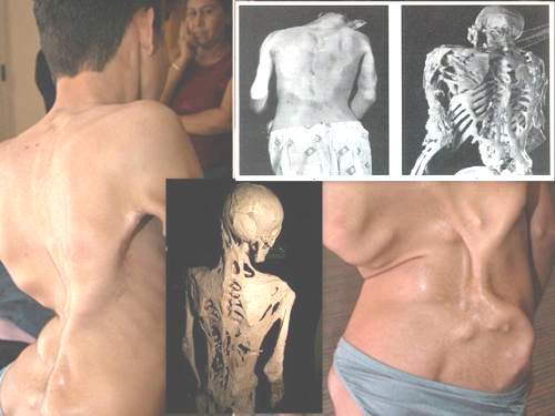 Hội chứng người hóa đá 1