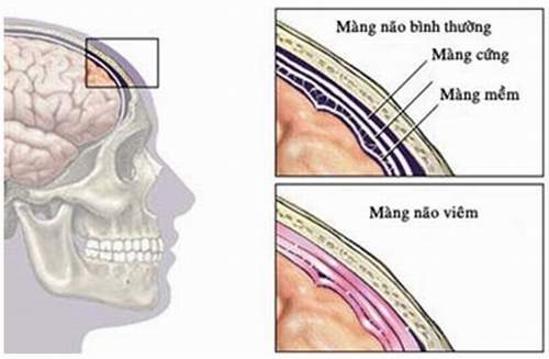 Lao màng não dễ bị bỏ qua, vì sao? 1