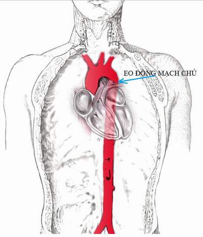 Can thiệp thành công ca vỡ eo động mạch chủ  2