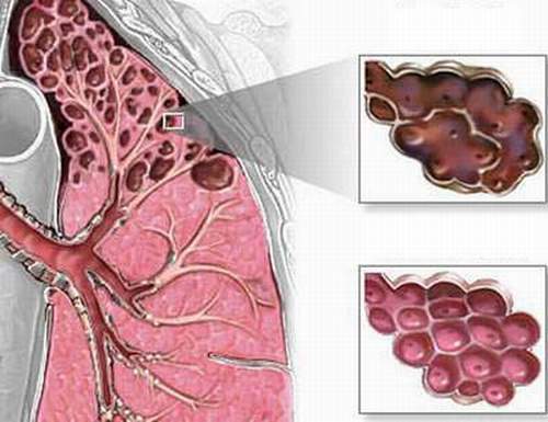 Phòng ngừa biến chứng bệnh khí phế thũng 1