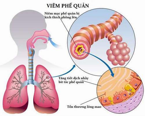 Chăm sóc trẻ bị viêm phế quản phổi 1