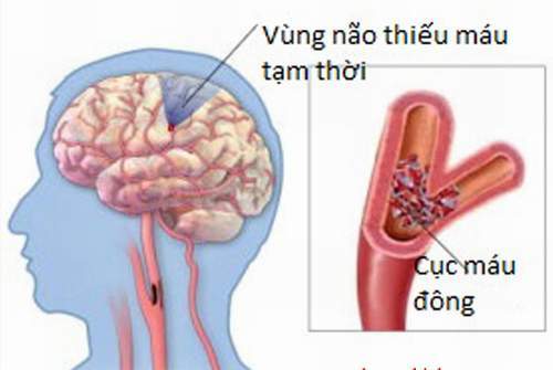 Để giảm biến chứng thiểu năng tuần hoàn não 1