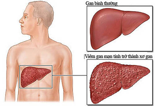 Biến chứng nguy hiểm của viêm gan B mạn tính