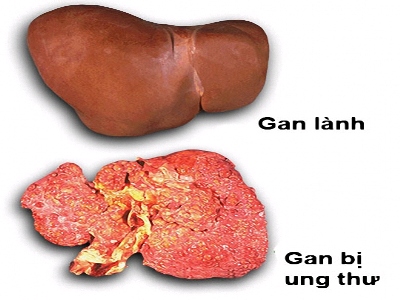 Viêm gan siêu vi B - Sát thủ thầm lặng 2