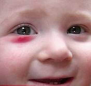 Xử lý chấn thương mắt ở trẻ em 1