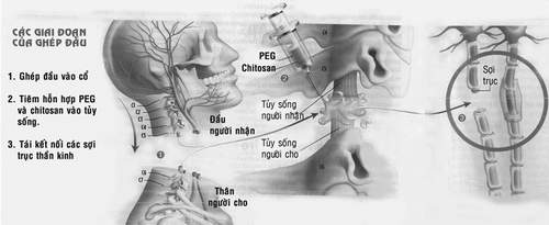 Ghép đầu - Dự án táo bạo có thành hiện thực? 1