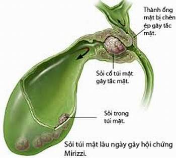 Điều trị sỏi túi mật 1