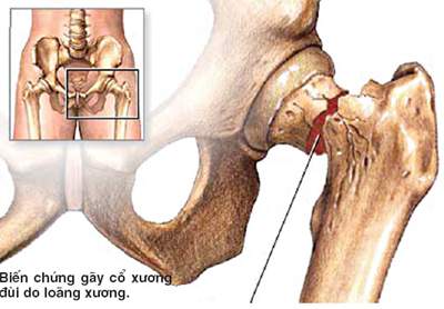 Thuốc điều trị loãng xương - Cần dùng liên tục  1