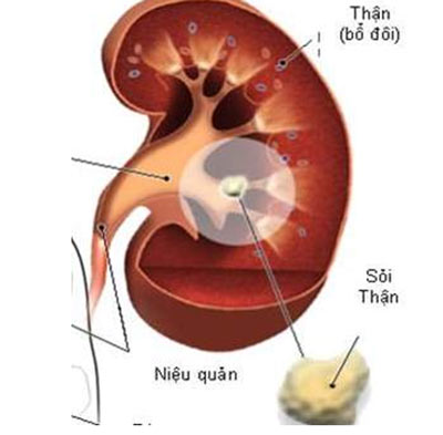 Làm gì khi phát hiện sỏi thận? 1