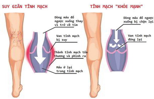 Hình ảnh giãn tĩnh mạch chi dưới.