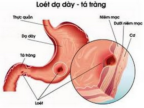 Vỏ hàu sông chữa viêm loét dạ dày-tá tràng.