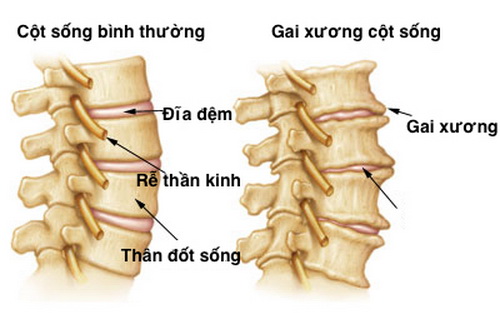 Cột sống bình thường và cột sống bị thoái hóa.