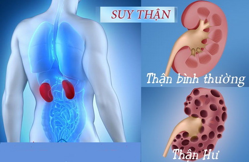 Suy thận - một biến chứng của chứng an thần kinh ác tính do thuốc an thần.