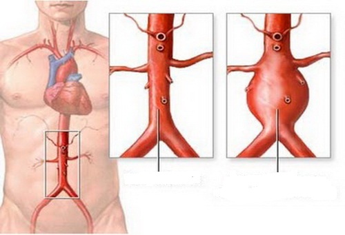 Phình động mạch chủ bụng gây đau lưng.