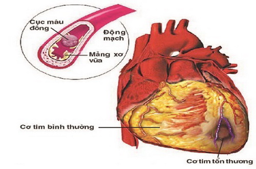 Cục máu đông làm tắc mạch vành.