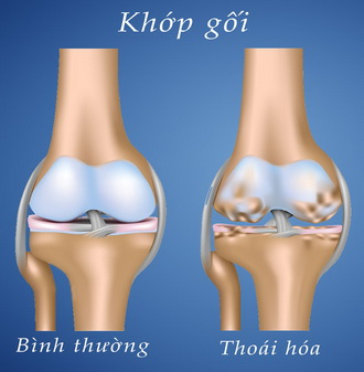 Thoái hóa khớp gối.