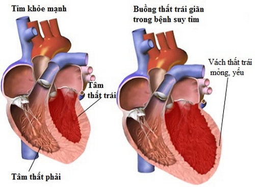 Biến Chứng Của Nhồi Máu Cơ Tim