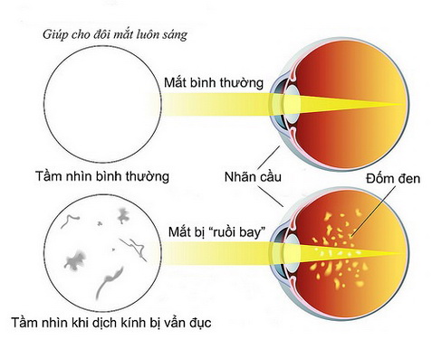 So sánh hình ảnh của mắt bình thường và mắt bị “ruồi bay”.