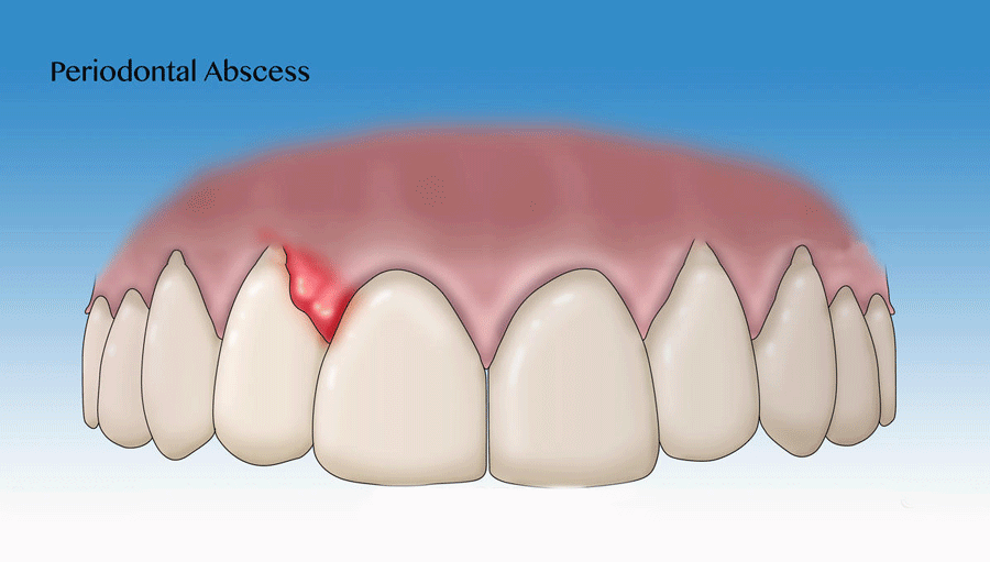 Áp xe nha chu – bệnh lý răng miệng nguy hiểm thường gặp