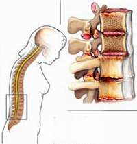 Viêm cột sống dính khớp, uống thuốc gì?