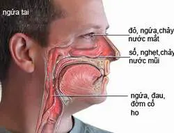 Viêm mũi dị ứng dễ nhầm với viêm xoang
