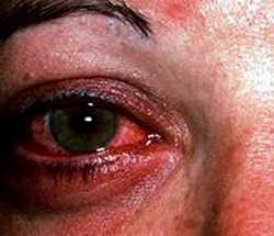 Có nên dùng kháng sinh chữa đau mắt đỏ?