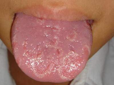 Lưỡi và những bệnh thường gặp