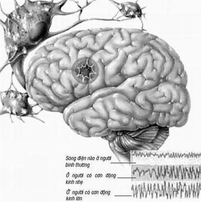 Não của người bệnh động kinh
