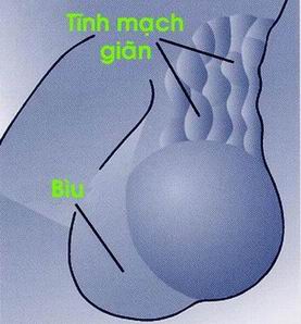 Giãn tĩnh mạch tinh.