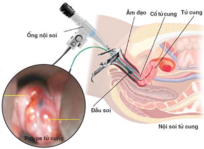 Bệnh lý lành tính niêm mạc tử cung