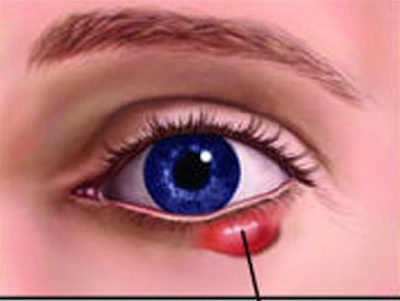 Bệnh đau mắt đỏ và cách phòng tránh